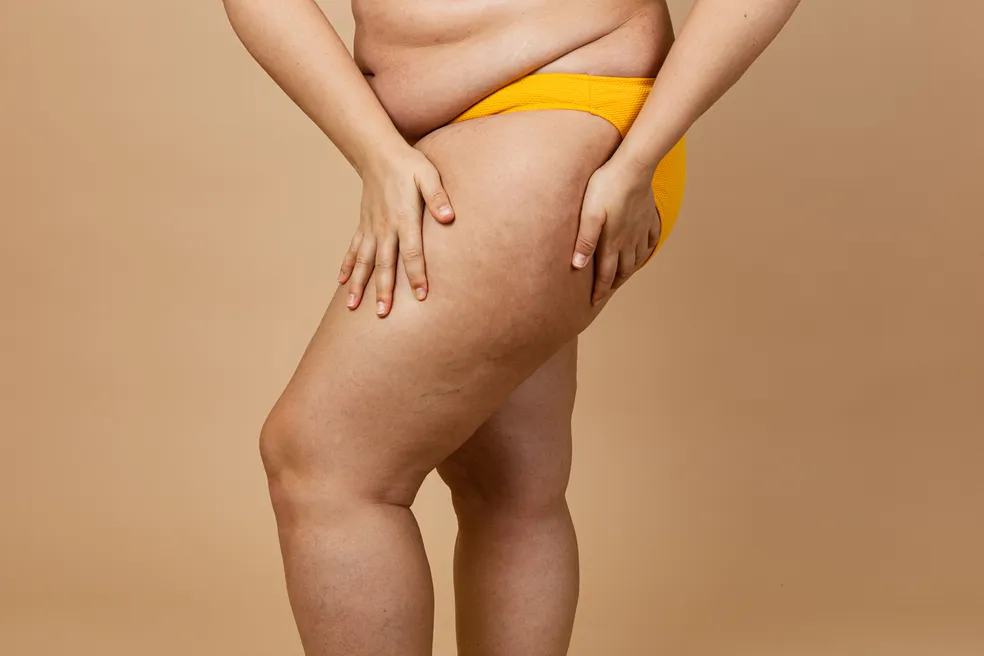 lipedema-gordura-perna-saude